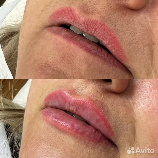 Увеличение губ