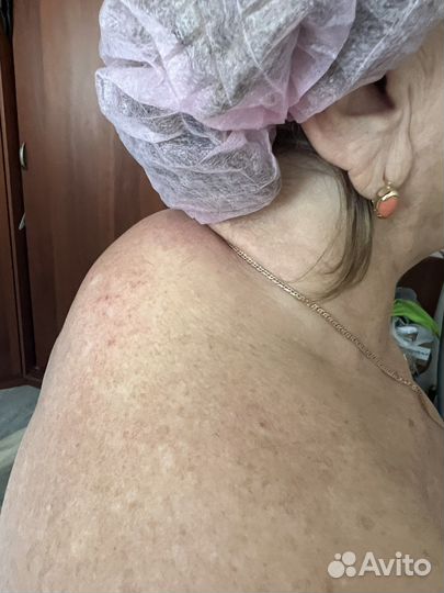 Липосакция аппаратная