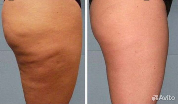 Антицеллюлитный массаж ручной,релакс,массаж лица