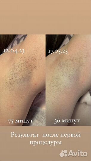 Электроэпиляция: голени