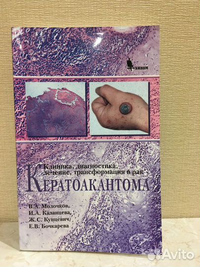 Кератоакантома