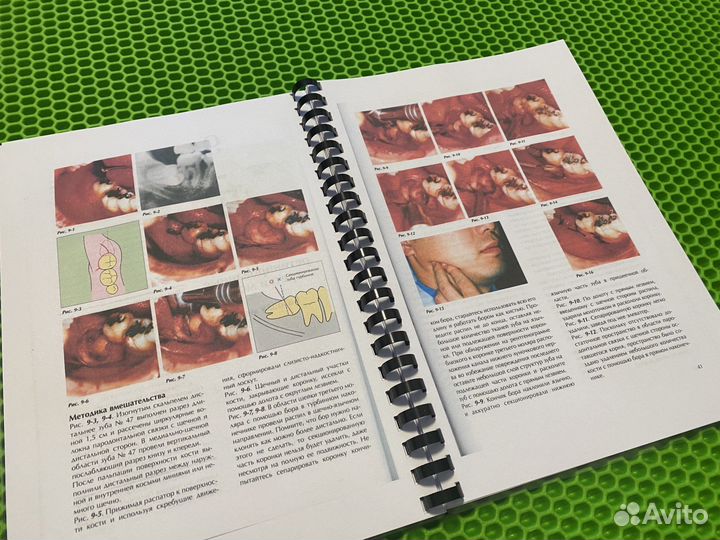 Удаление третьих моляров