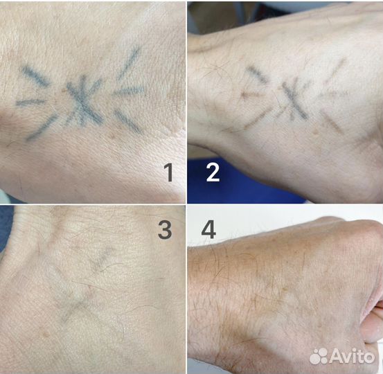 Удаление татуажа/тату