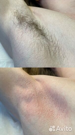 Депиляция шугаринг/ваксинг