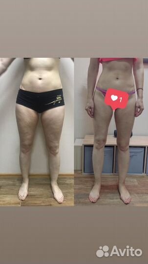 LPG массаж на оригинальном аппарате vortex