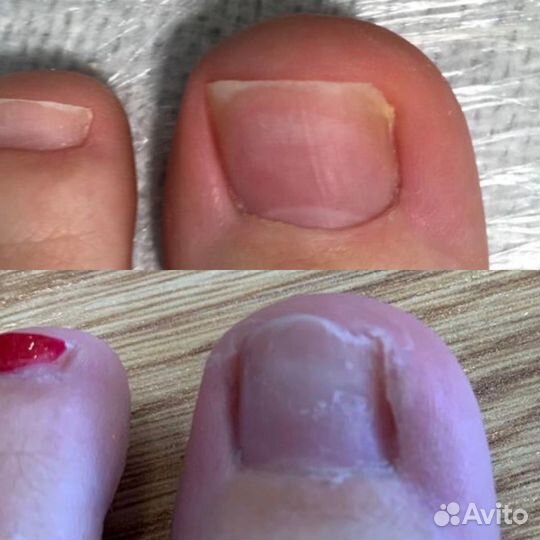 Педикюр медицинский / подолог