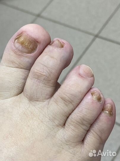 Подолог/Педикюр/Вросший ноготь/Мозоль