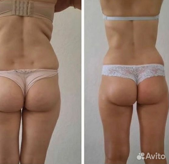 Коррекция фигуры, антицеллюлитный массаж, массаж