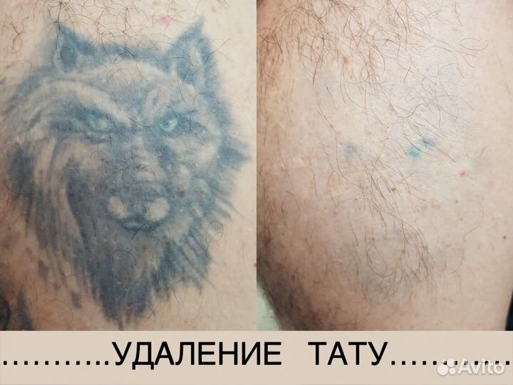 Удаление тату лазером