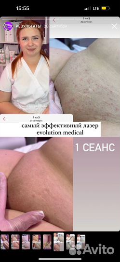 Лазерная эпиляция