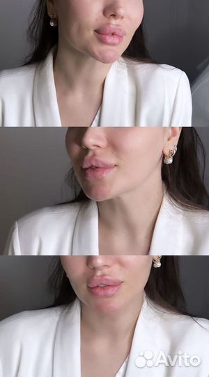 Модели на увеличение губ и контурную пластику лица
