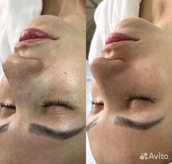 Чистка лица