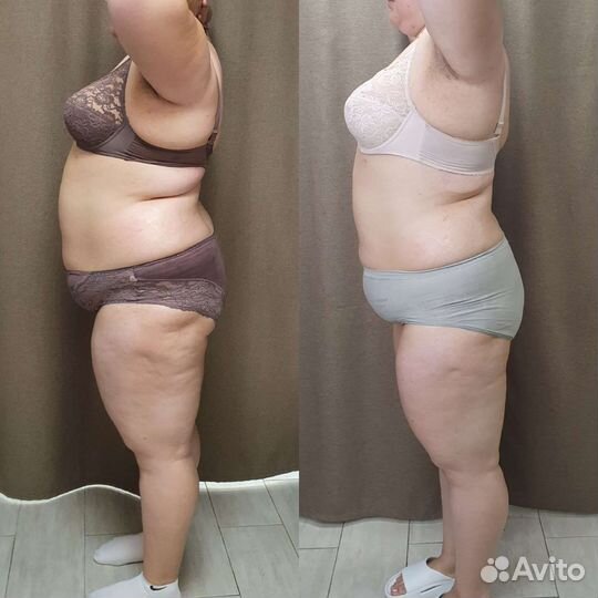 Криолиполиз, кавитация, ваккумный массаж