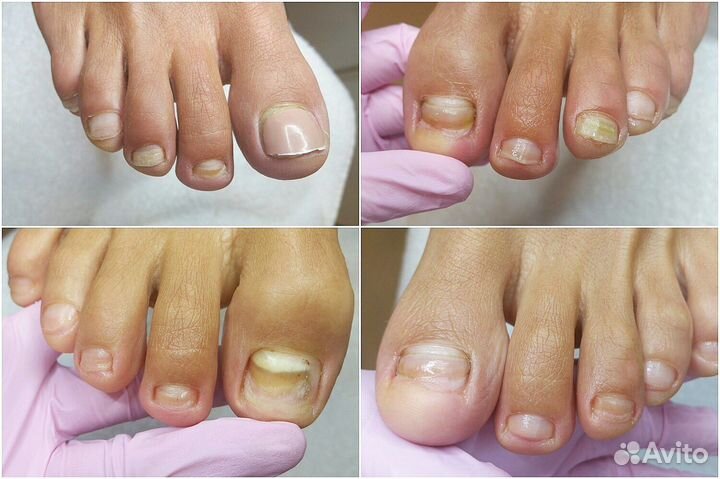 Подологический педикюр