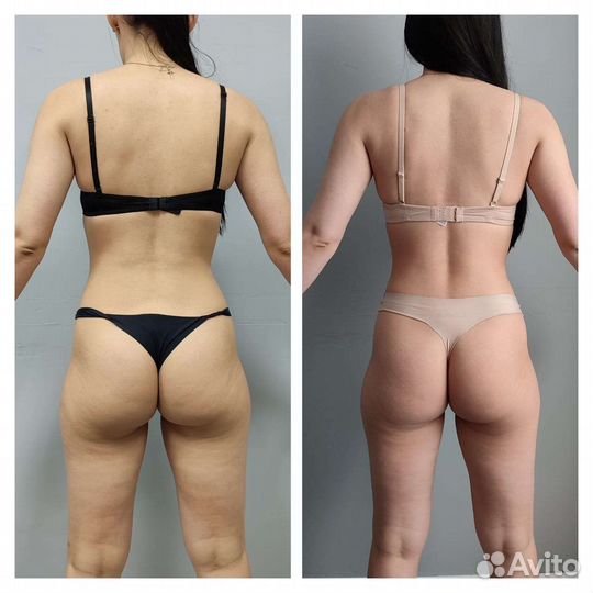 LPG массаж,ручной массаж,прессотерапия мио.ия