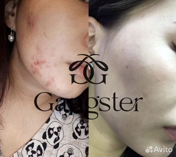 Болтушка для проблемной кожи