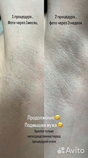 Лазерная эпиляция