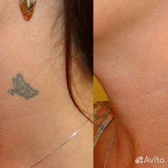 Удаление татуажа.Карбоновый пилинг.Обучение