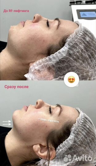 Омоложение лица рф-лифтинг