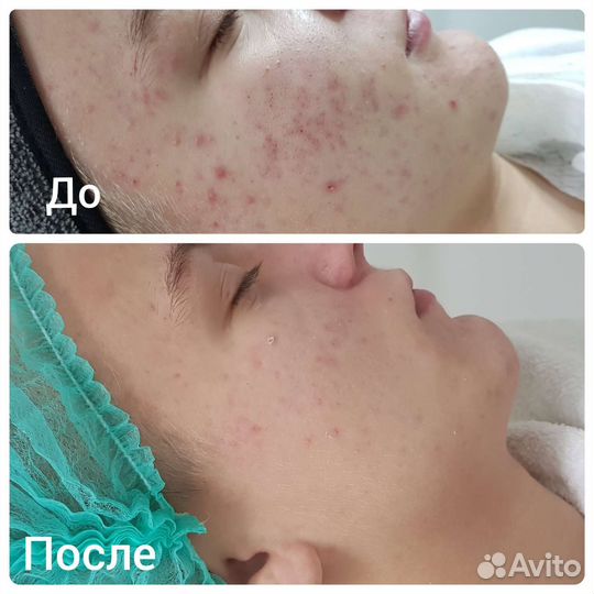 Механическая чистка лица