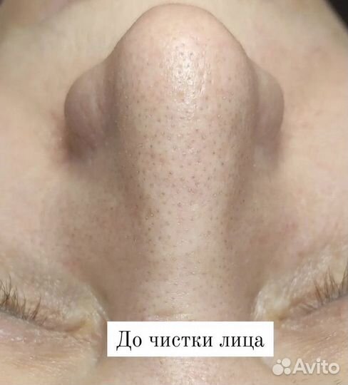 Чистка лица