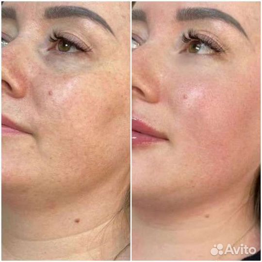 Мезоботокс, Коктейль Монако