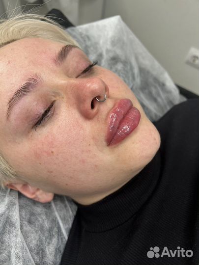 Увеличение губ Аугментация губ