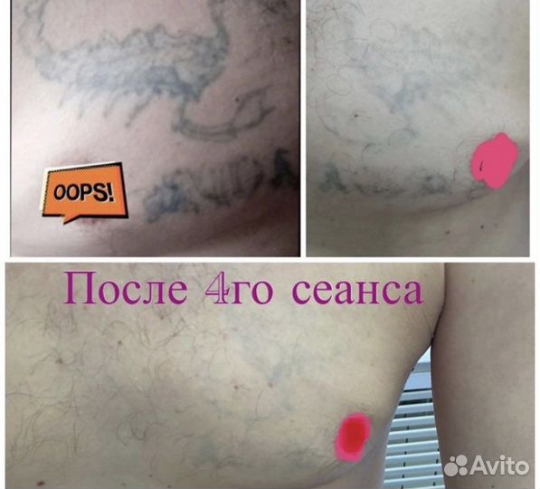 Удаление тату,татуажа