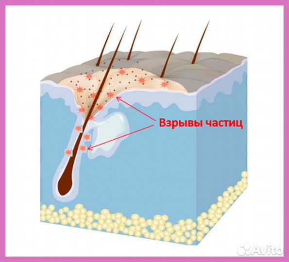 Карбоновый пилинг