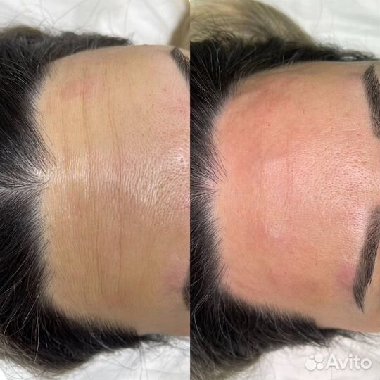 Ботокс для лица