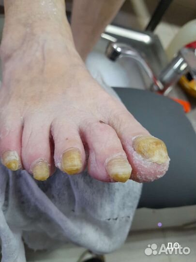 Педикюр любой сложности