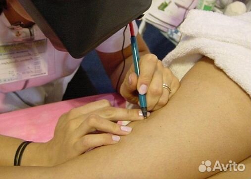 Удаление купероза, сосудистых звездочек, розацеа