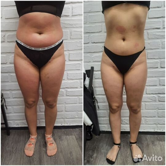 Аппаратный массаж