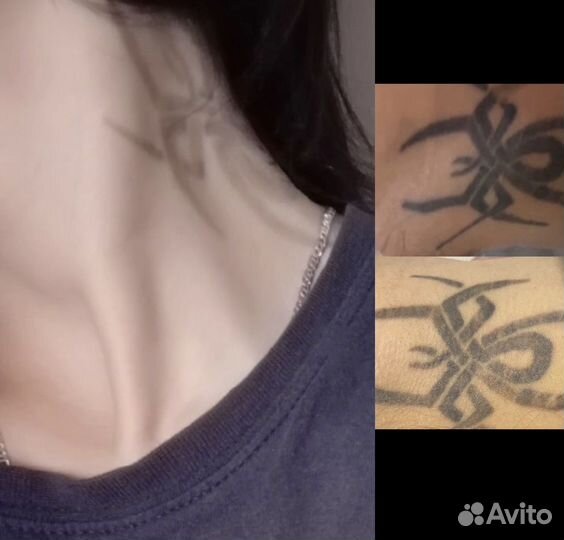 Лазерное удаление татуажа и татуировок