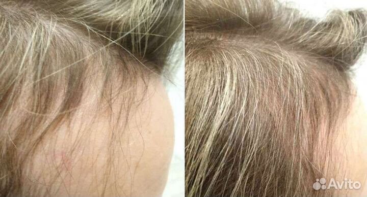 Мезотерапия волос, выпадение, облысение, алопеция