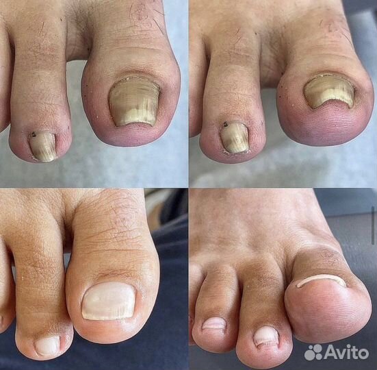 Медицинский педикюр подолог