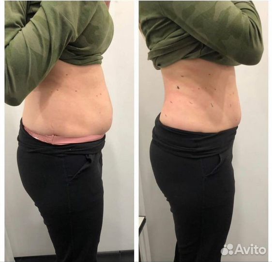 Кавитация,rf лифтинг, вакуумный массаж