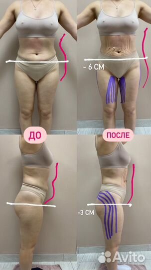 Тейпирование