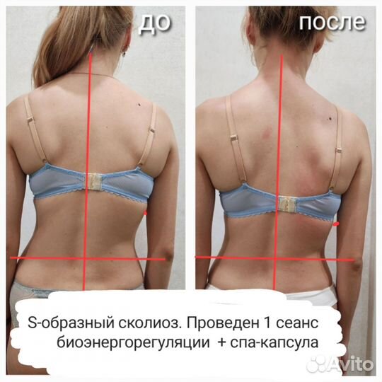 Массаж, коррекция осанки (сколиоз, кифоз, лордоз)