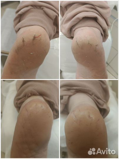 Подолог с выездом на дом