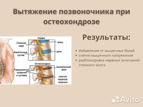 Массаж при остеохондрозе/ исправление осанки