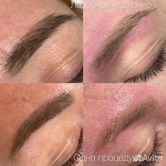 Удаление/осветление тату и татуажа лазером