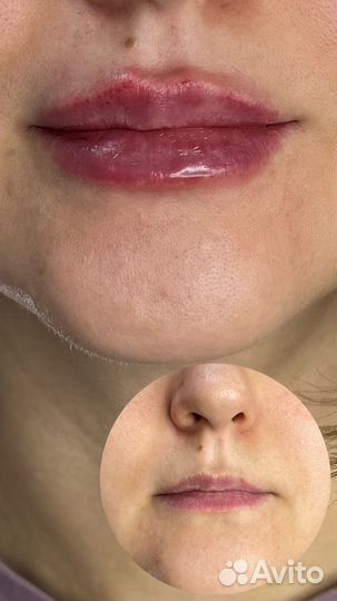 Ботулинотерапия