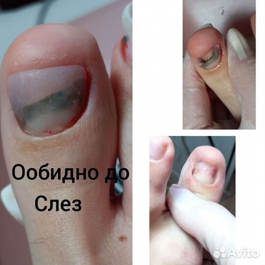 Педикюр любой сложности, вросший ноготь вс,подолог