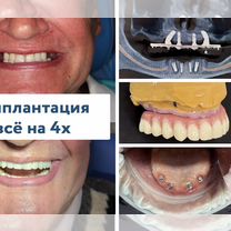Имплантация зубов all on 4 (все на 4), Москва