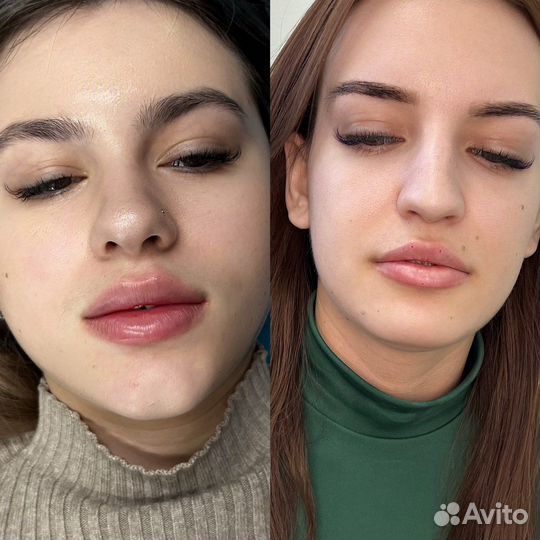 Контурная пластика