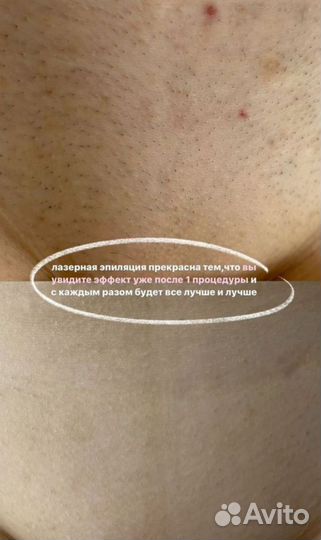 Лазерная эпиляция