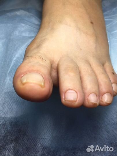 Аппаратный педикюр.Лечение вросшего ногтя, установ