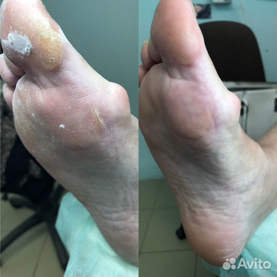 Медицинский педикюр подолог