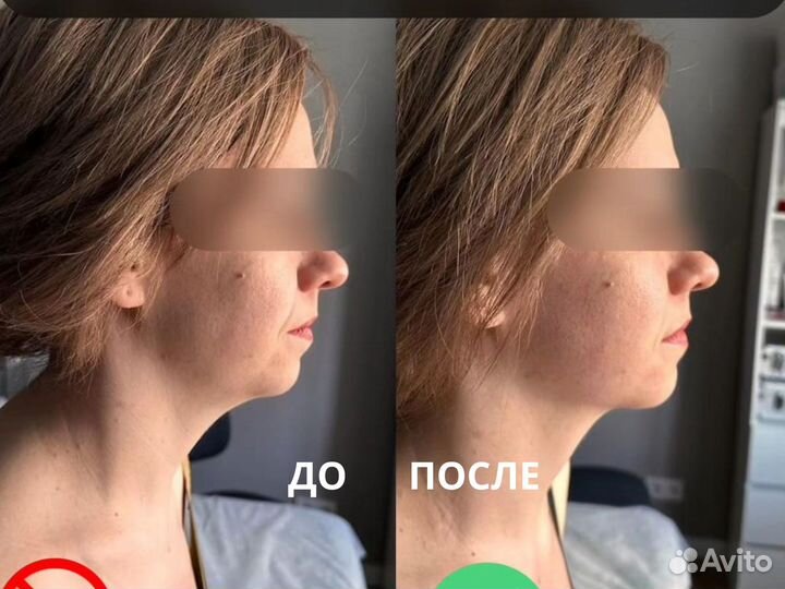 Массаж лица скульптурный. За 1 уменьшится овал лиц